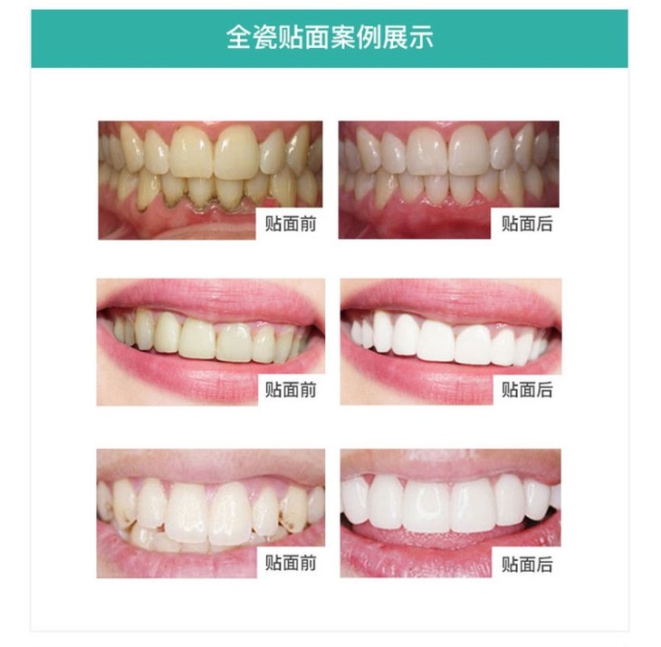全瓷貼面可以用于牙齒的美白